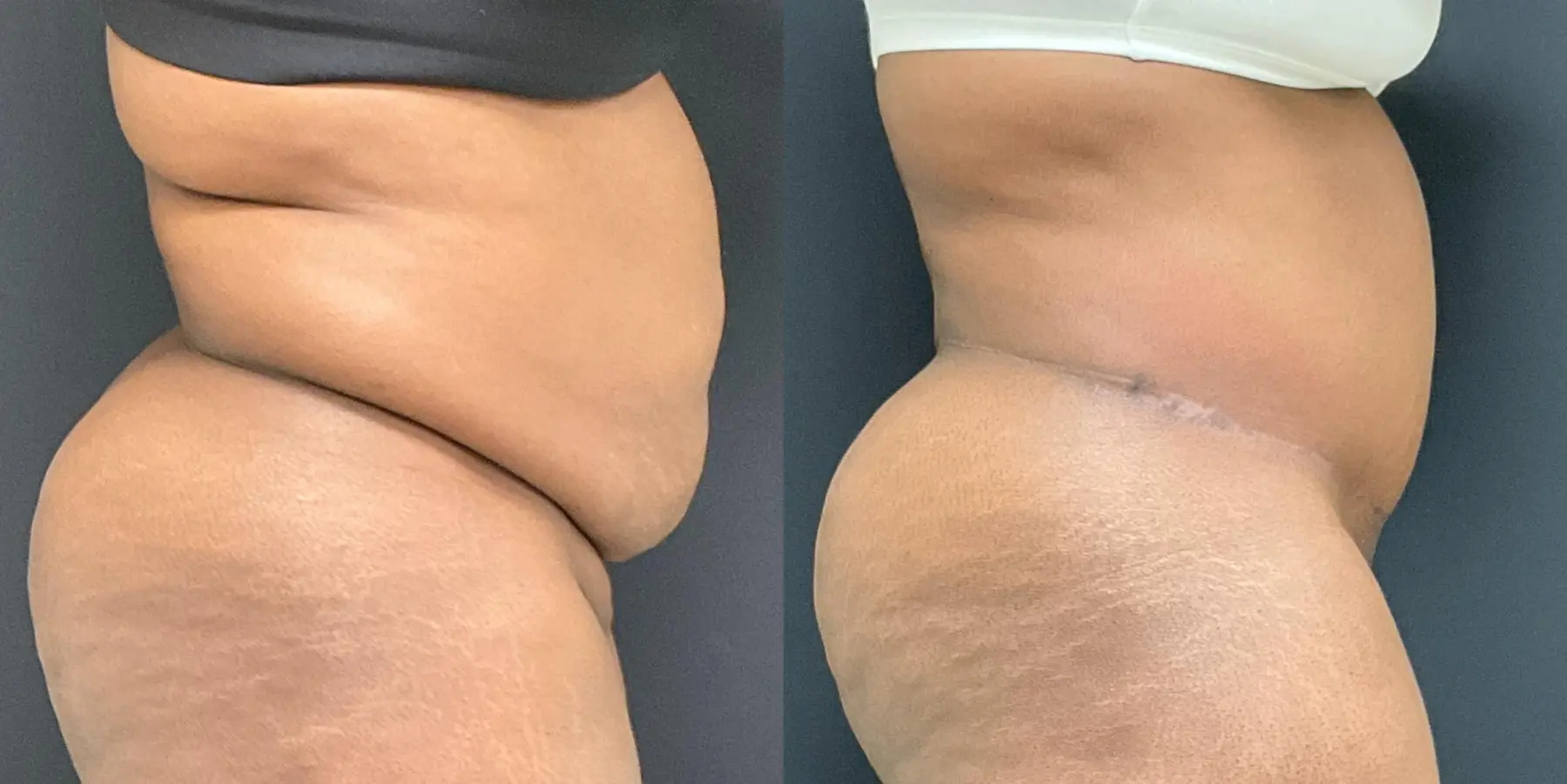 Tummy Tuck: Patient 24 - Before and After 5