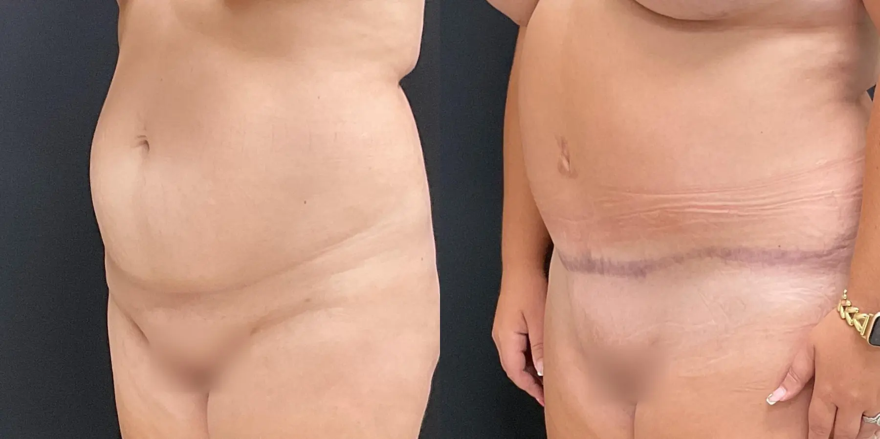 Tummy Tuck: Patient 22 - Before and After 2