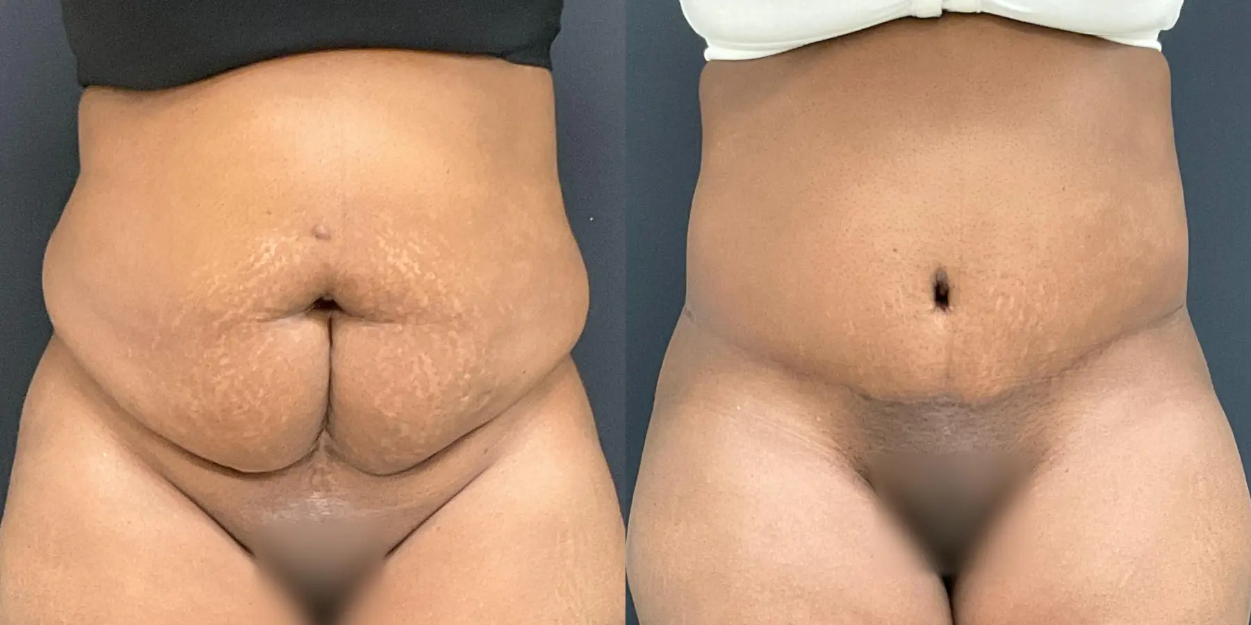 Tummy Tuck: Patient 24 - Before and After 1
