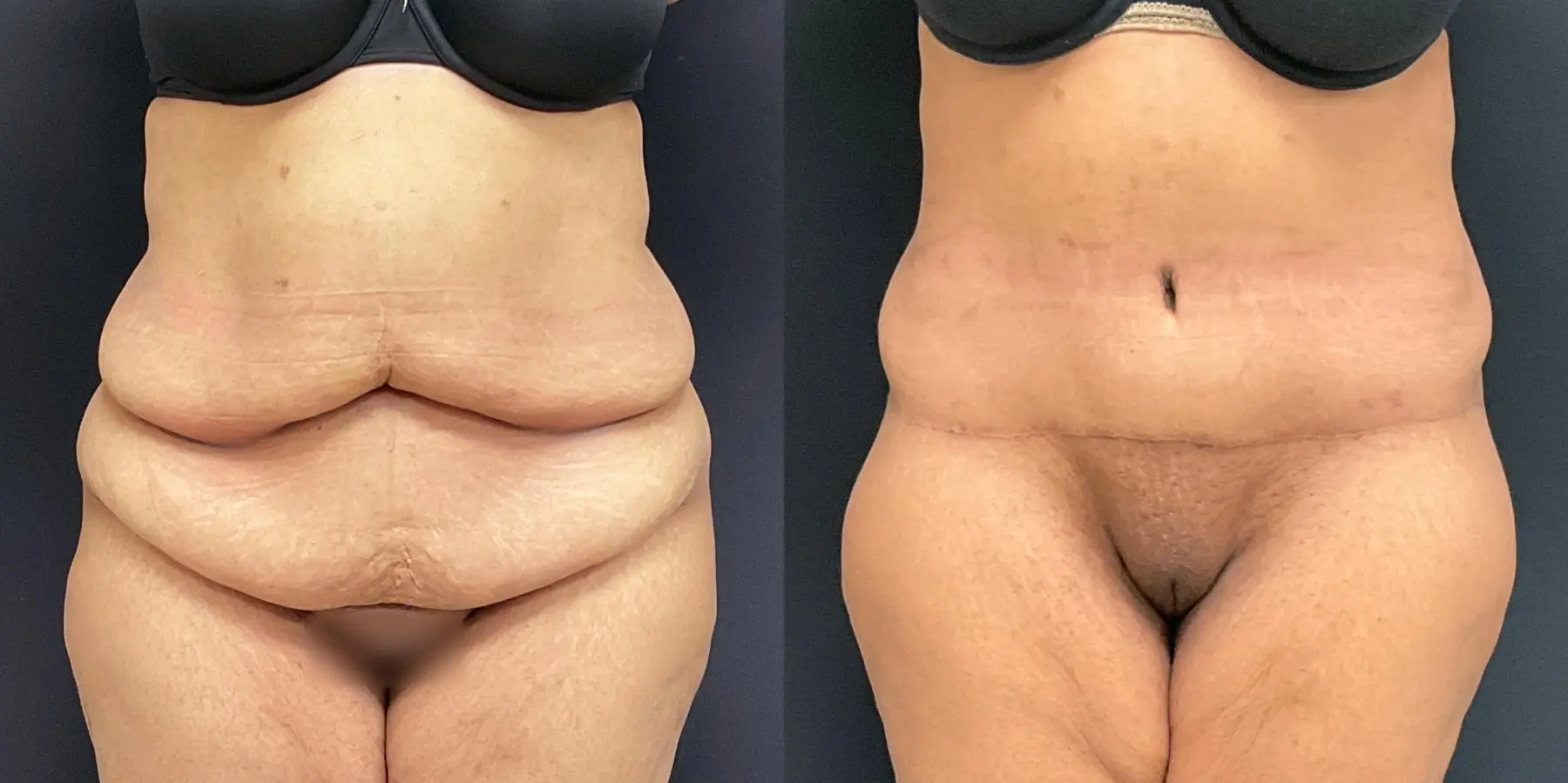 Tummy Tuck: Patient 16 - Before and After  
