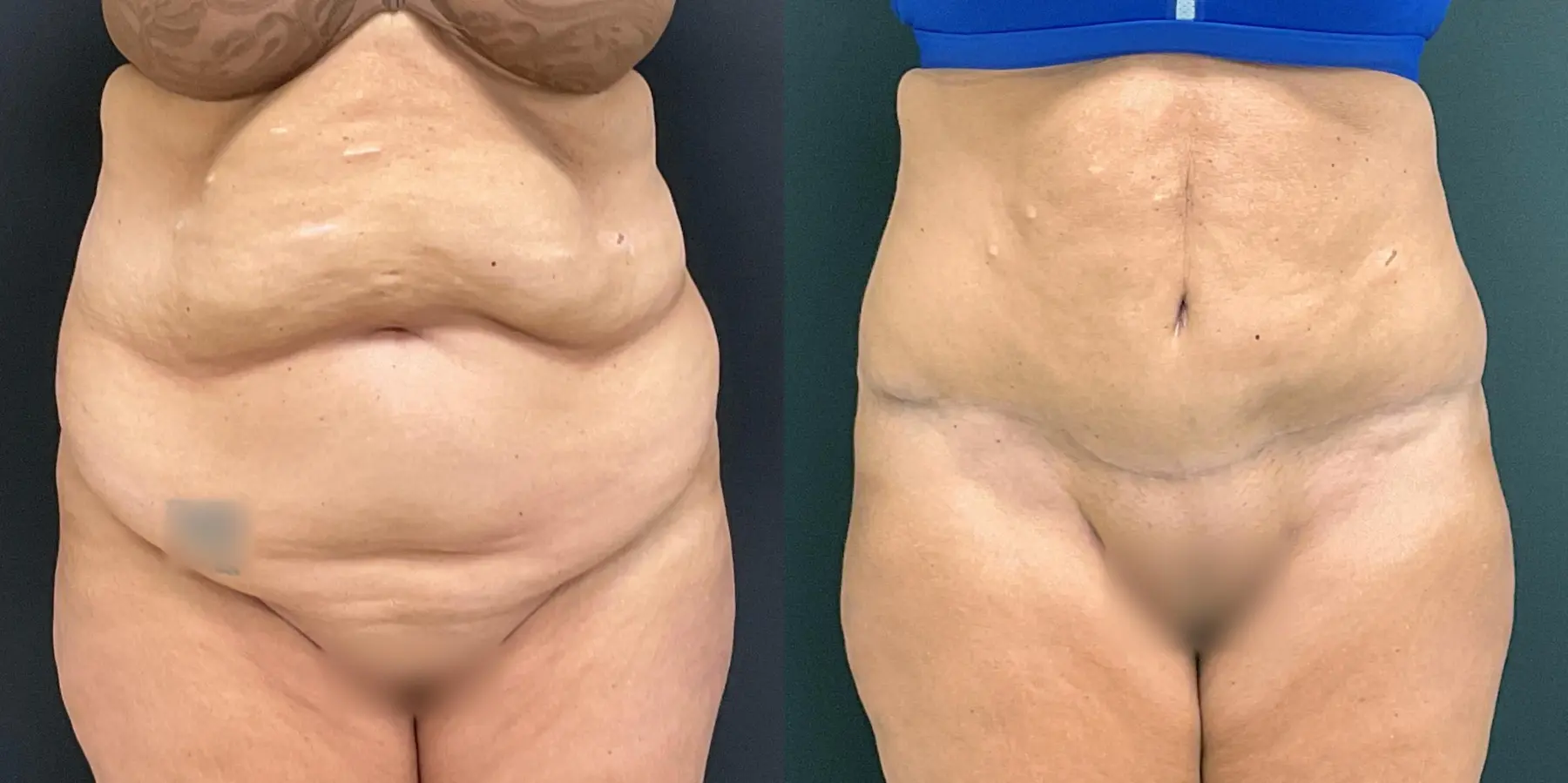 Tummy Tuck: Patient 23 - Before and After 1