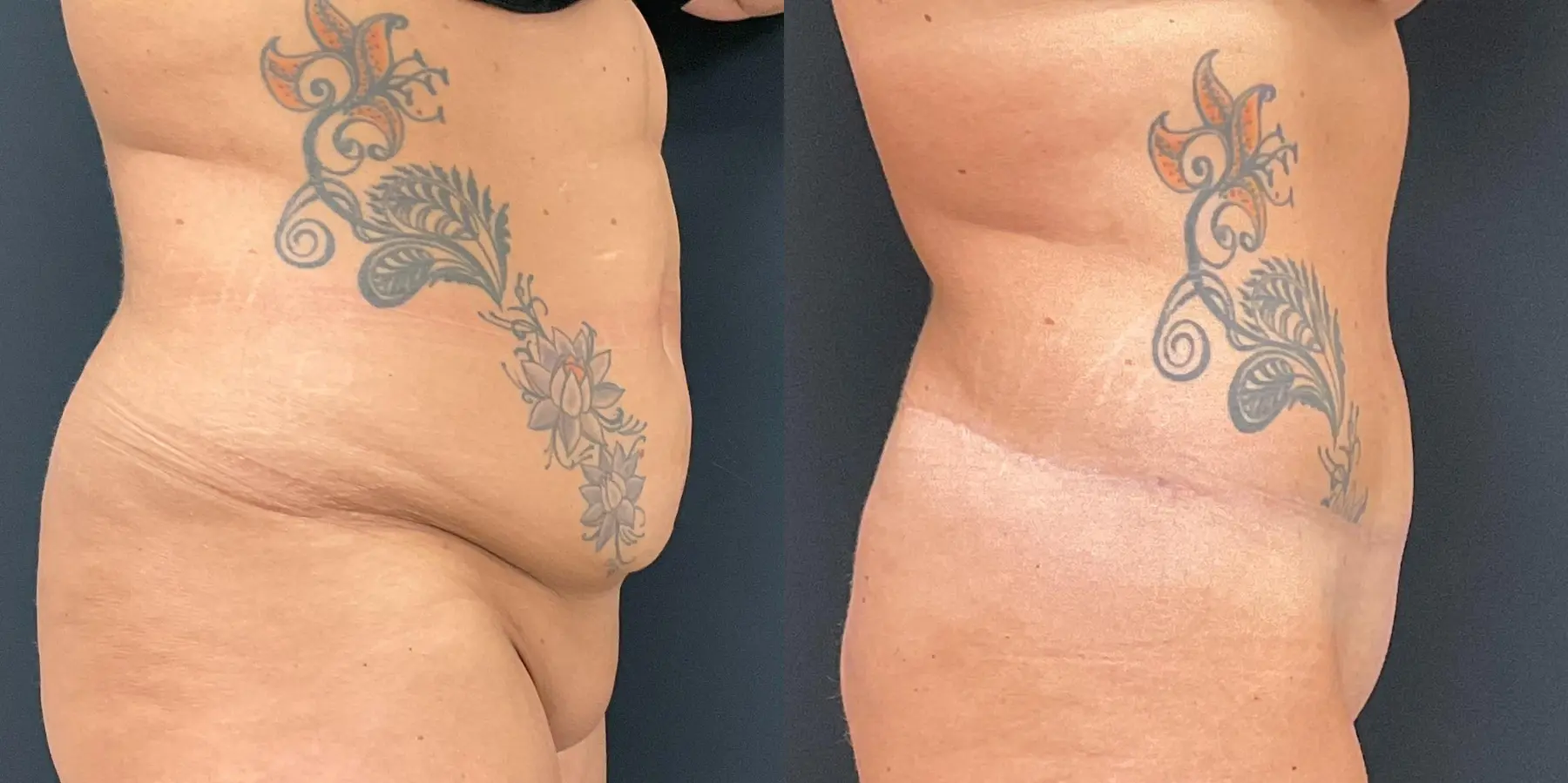 Tummy Tuck: Patient 19 - Before and After 5
