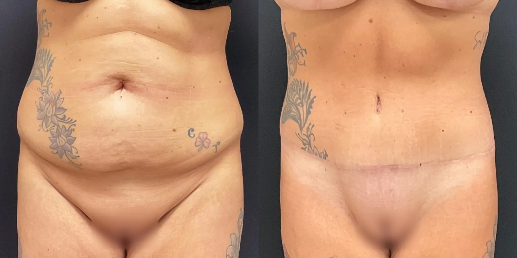 Tummy Tuck: Patient 19 - Before and After 1