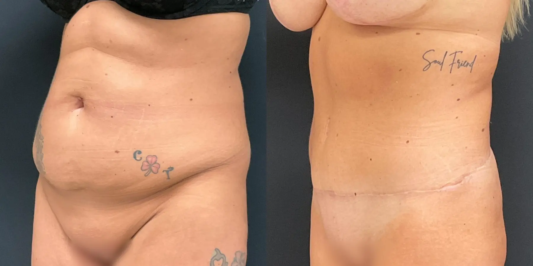 Tummy Tuck: Patient 19 - Before and After 2