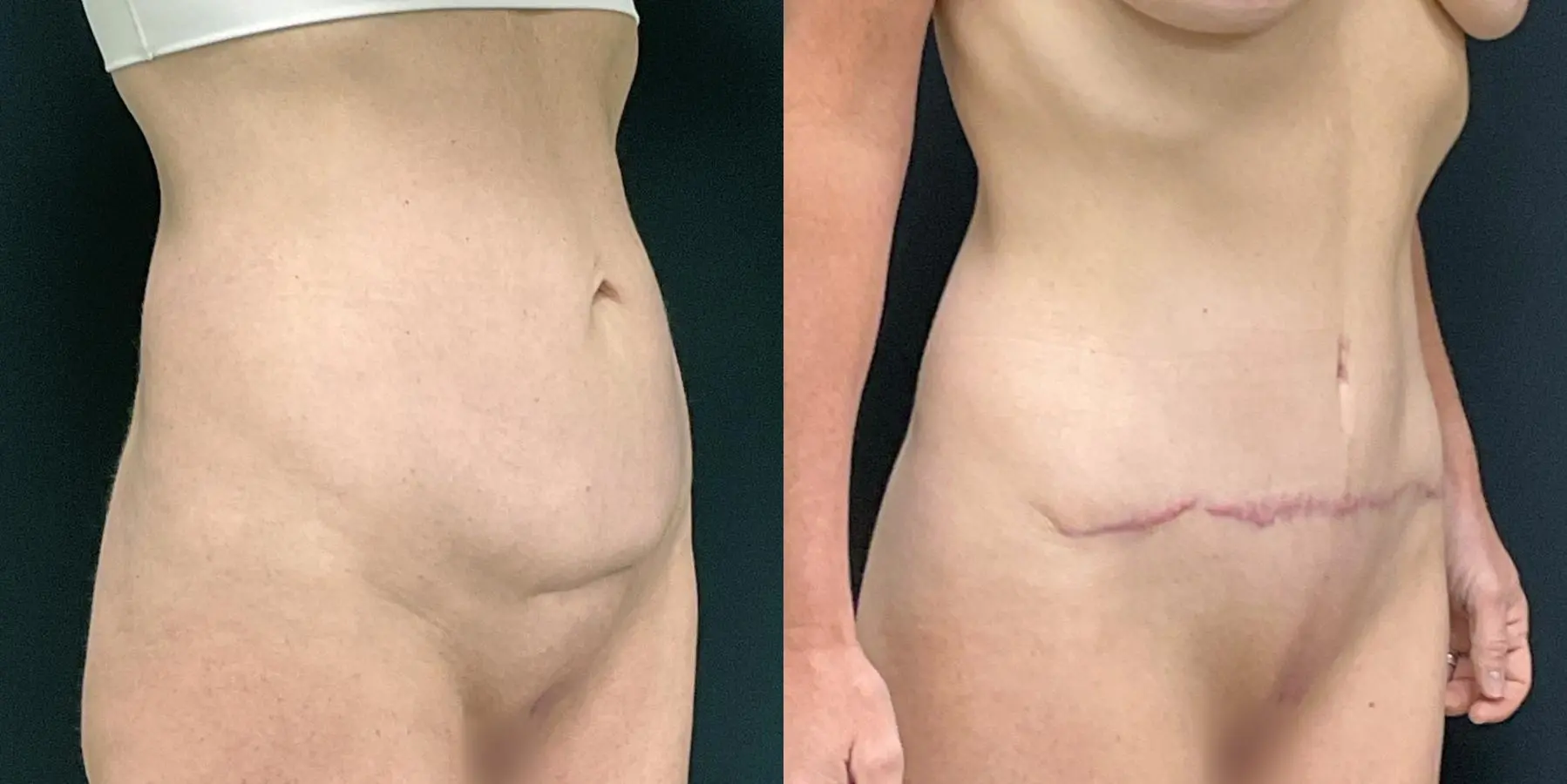 Tummy Tuck: Patient 28 - Before and After 3