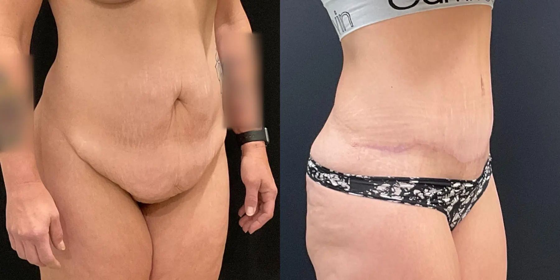Tummy Tuck: Patient 21 - Before and After 3