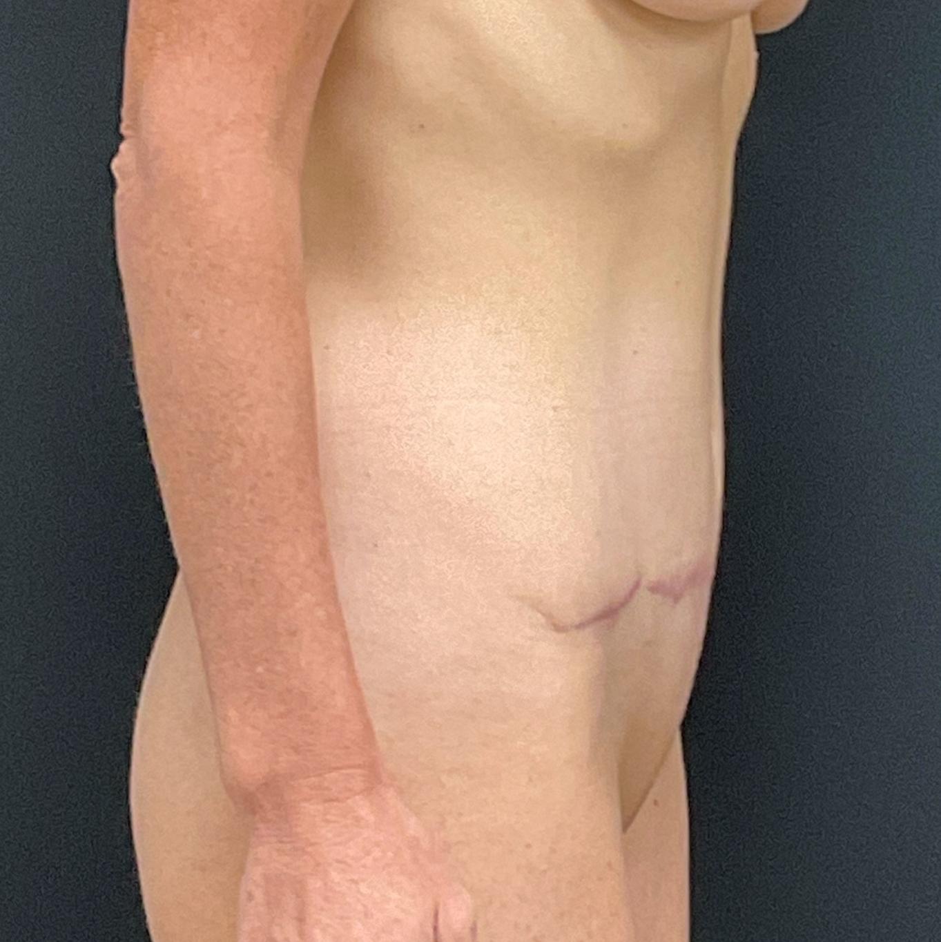 Mommy Makeover: Patient 14 - After 10