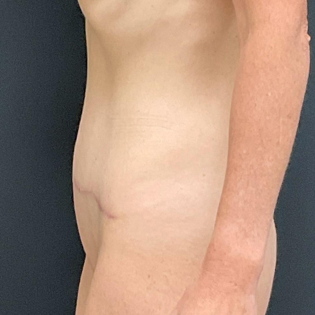 Mommy Makeover: Patient 14 - After 9