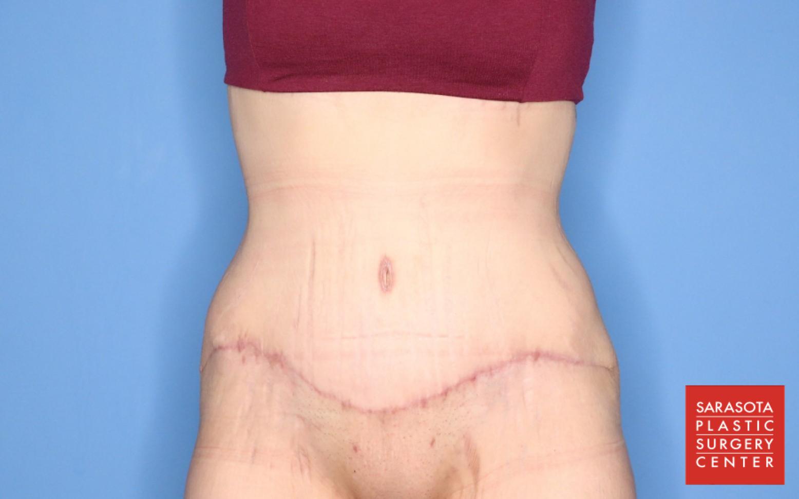 Abdominoplasty: Patient 2 - After  