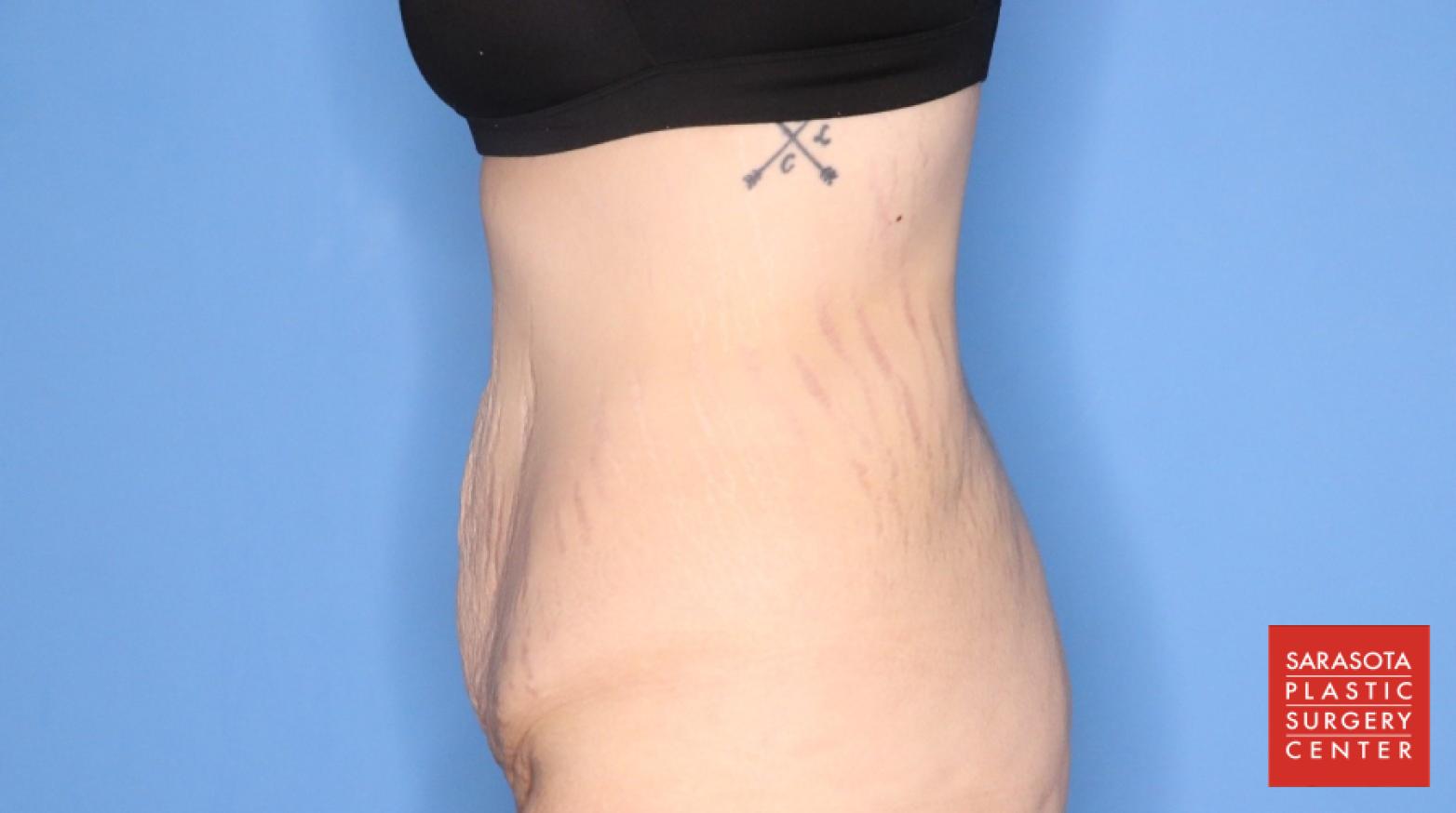 Abdominoplasty: Patient 3 - Before and After 5