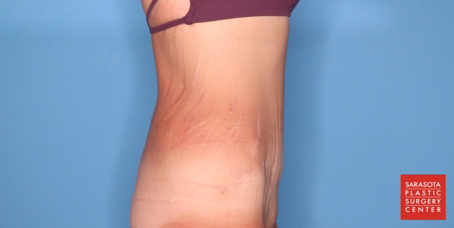 Abdominoplasty: Patient 3 - After 3_2