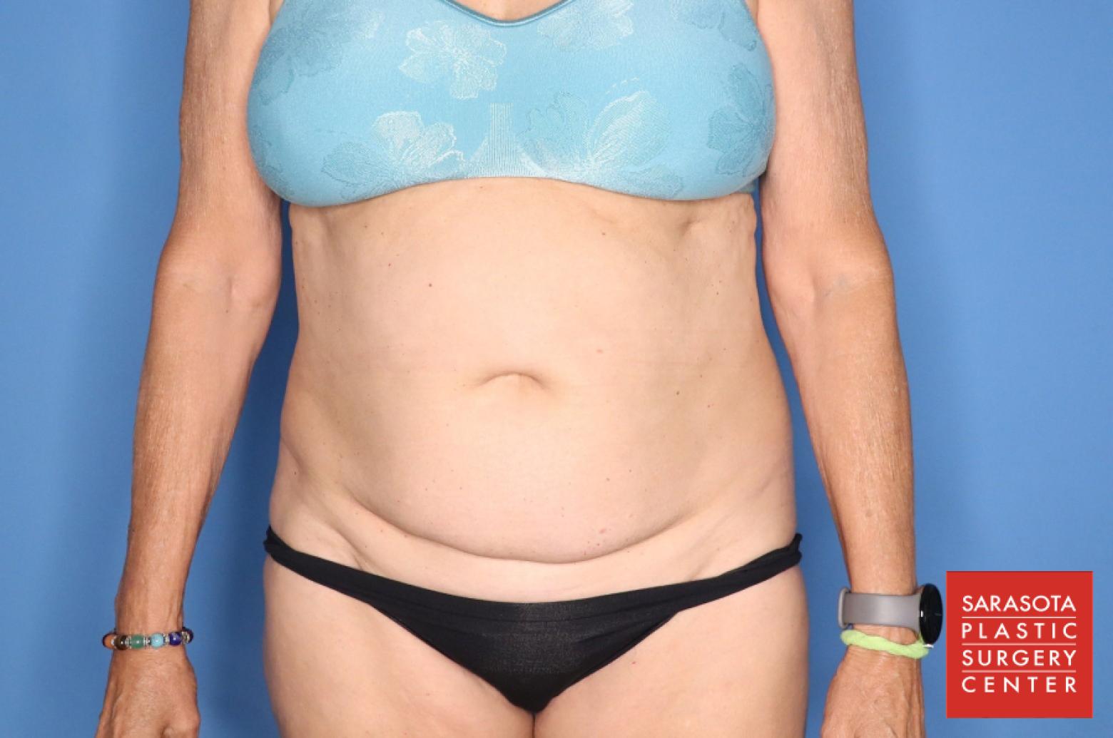 Abdominoplasty: Patient 3 - Before 