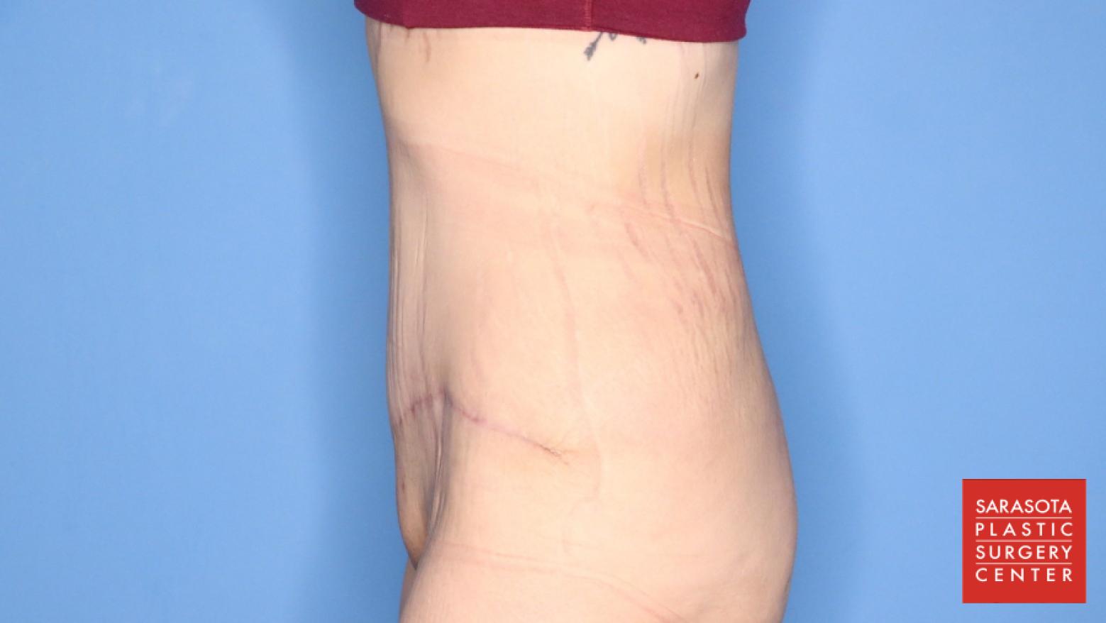 Abdominoplasty: Patient 3 - After 5