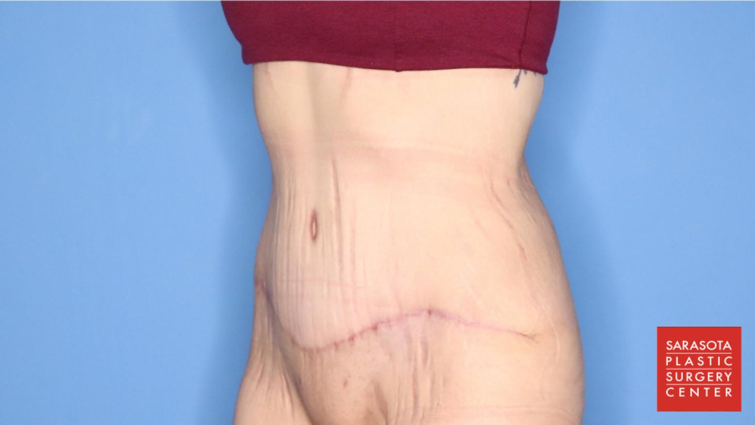 Abdominoplasty: Patient 3 - After 4