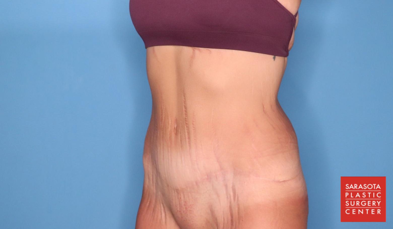 Abdominoplasty: Patient 3 - After 4_2