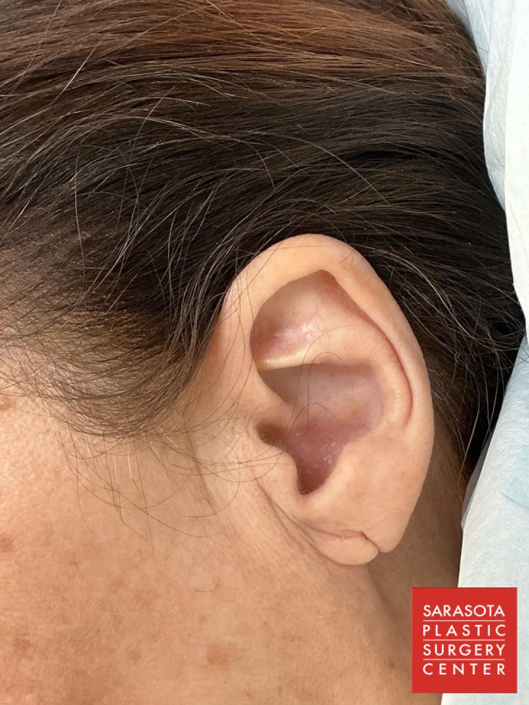 Earlobe Surgery: Patient 4 - Before 