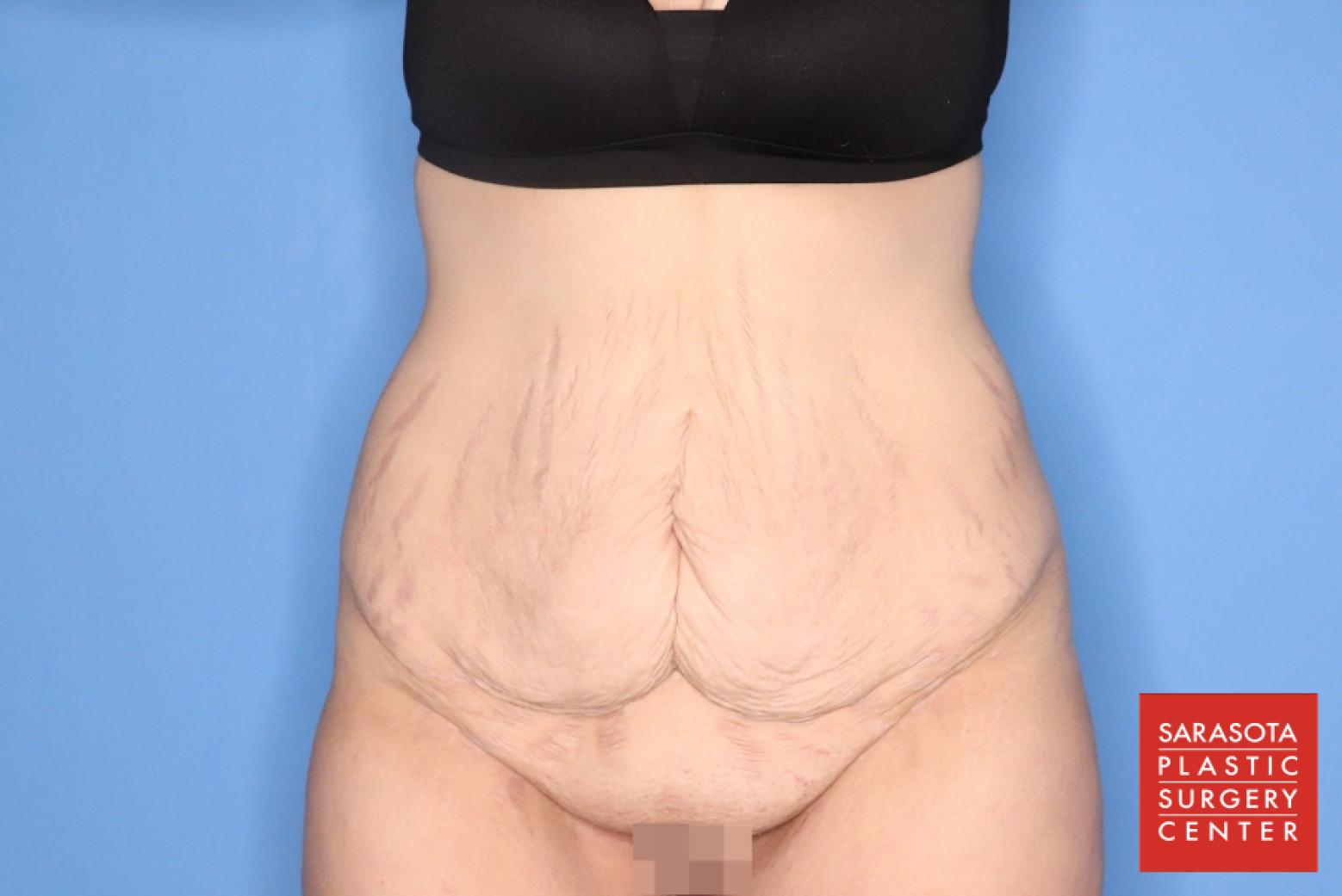 Abdominoplasty: Patient 2 - Before 