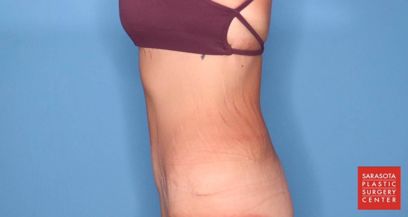 Abdominoplasty: Patient 3 - After 5_2