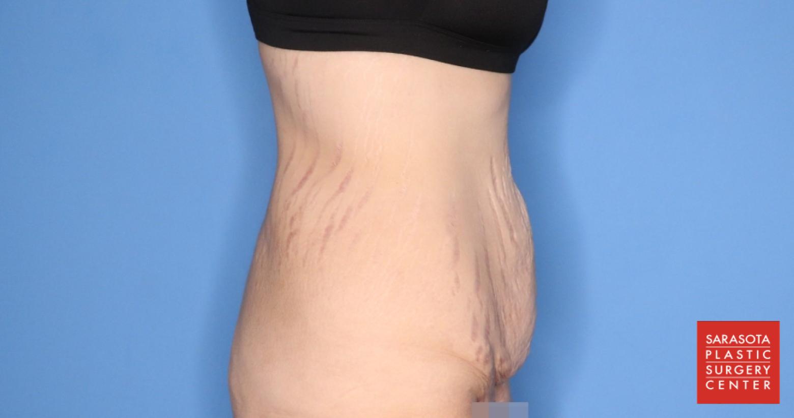 Abdominoplasty: Patient 3 - Before 3
