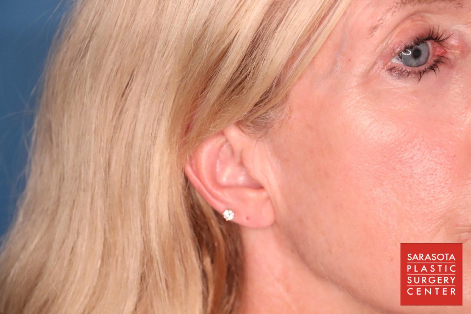 Earlobe Surgery: Patient 1 - After  