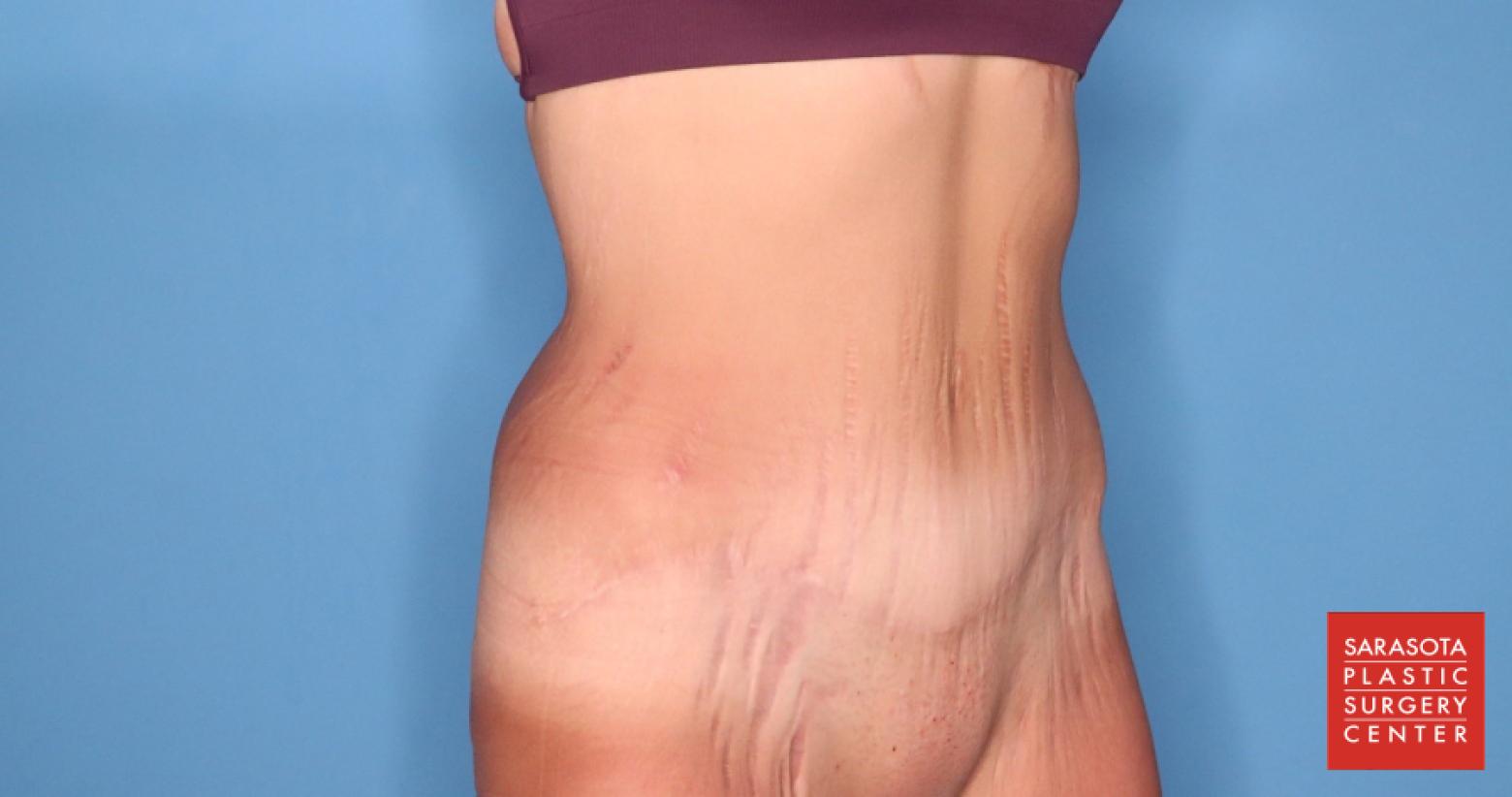 Abdominoplasty: Patient 3 - After 2_2
