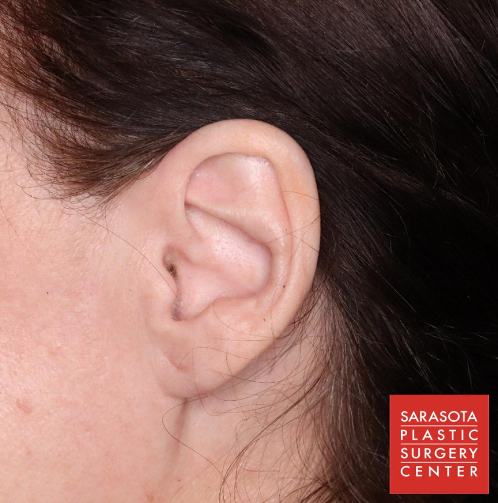 Earlobe Surgery: Patient 4 - After  