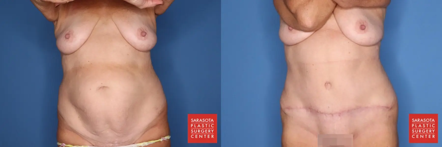 Abdominoplasty: Patient 5 - Before and After  