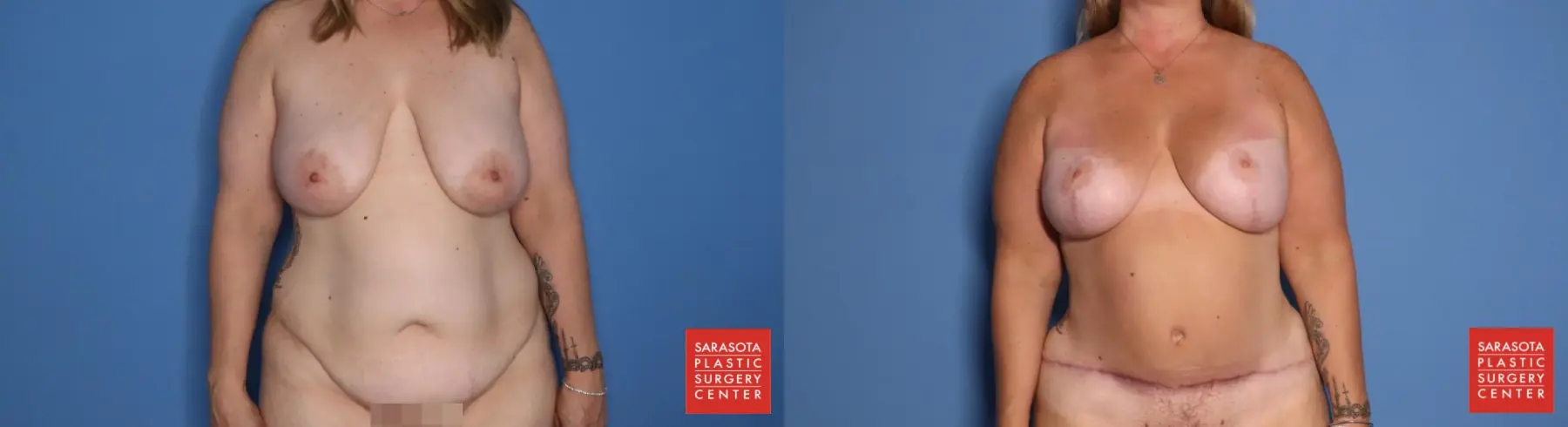 Abdominoplasty: Patient 8 - Before and After  