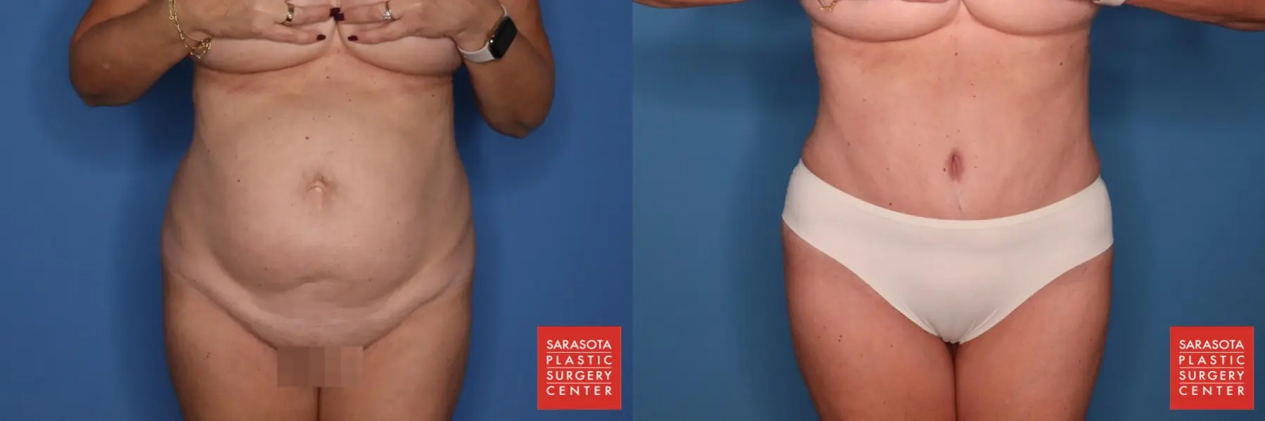 Abdominoplasty: Patient 9 - Before and After  