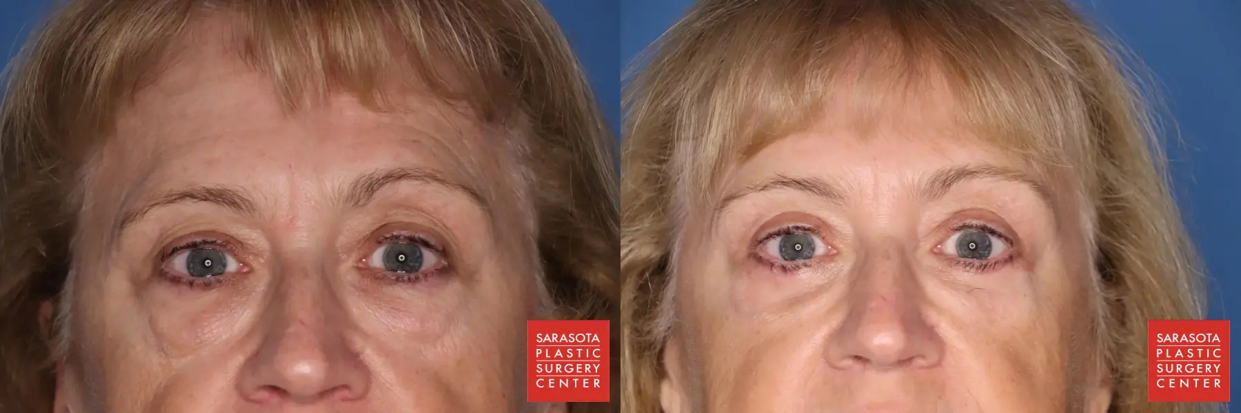 Blepharoplasty: Patient 3 - Before and After  