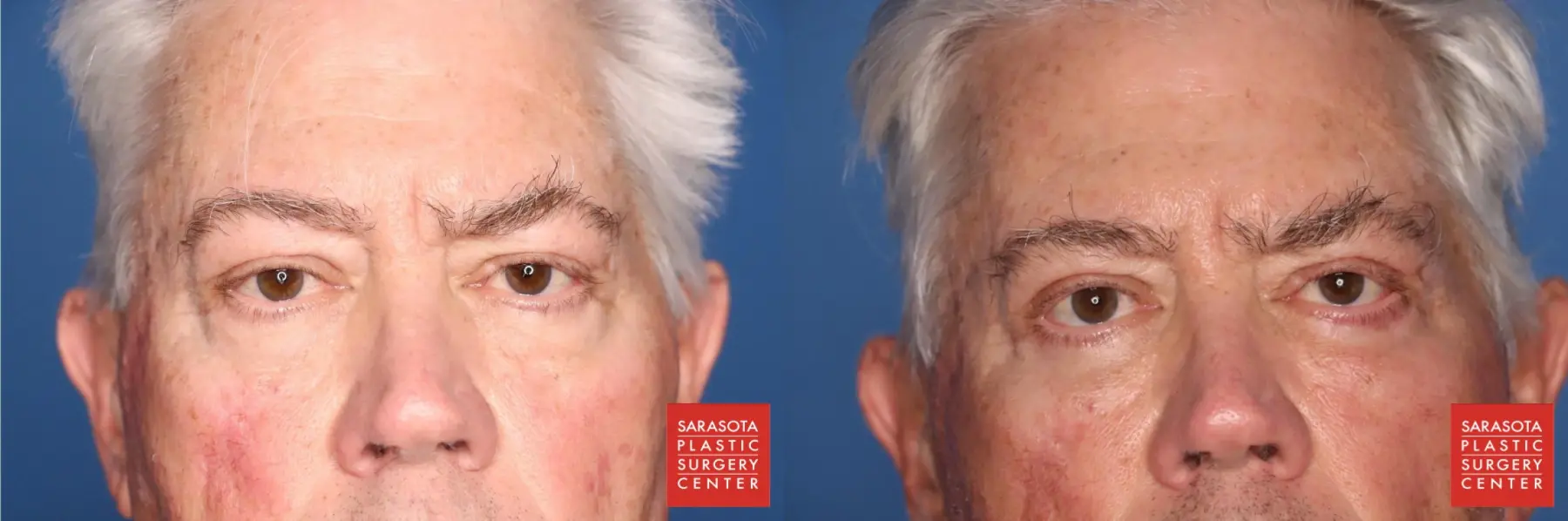 Blepharoplasty: Patient 4 - Before and After  