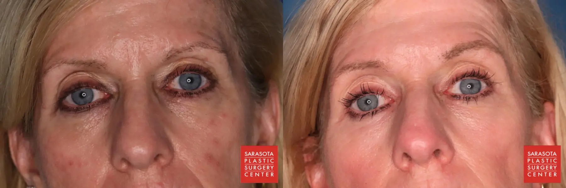 Blepharoplasty: Patient 3 - Before and After  
