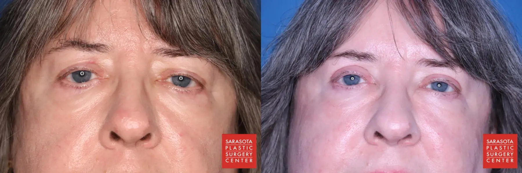 Blepharoplasty: Patient 4 - Before and After  