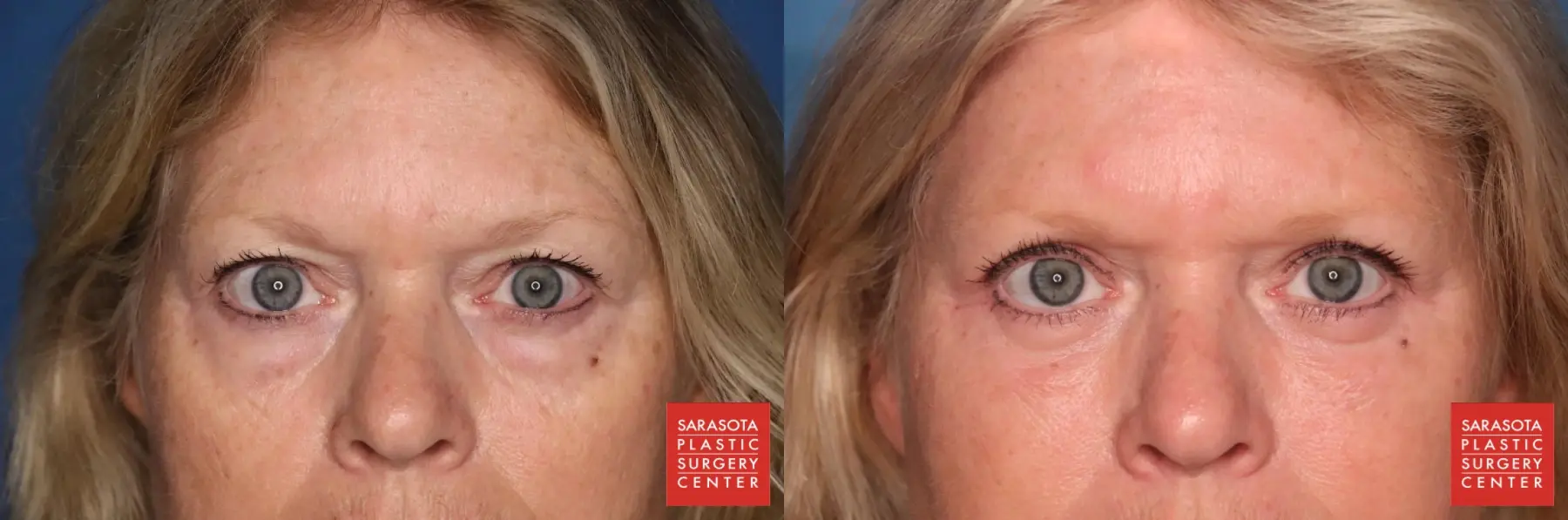 Blepharoplasty: Patient 1 - Before and After  