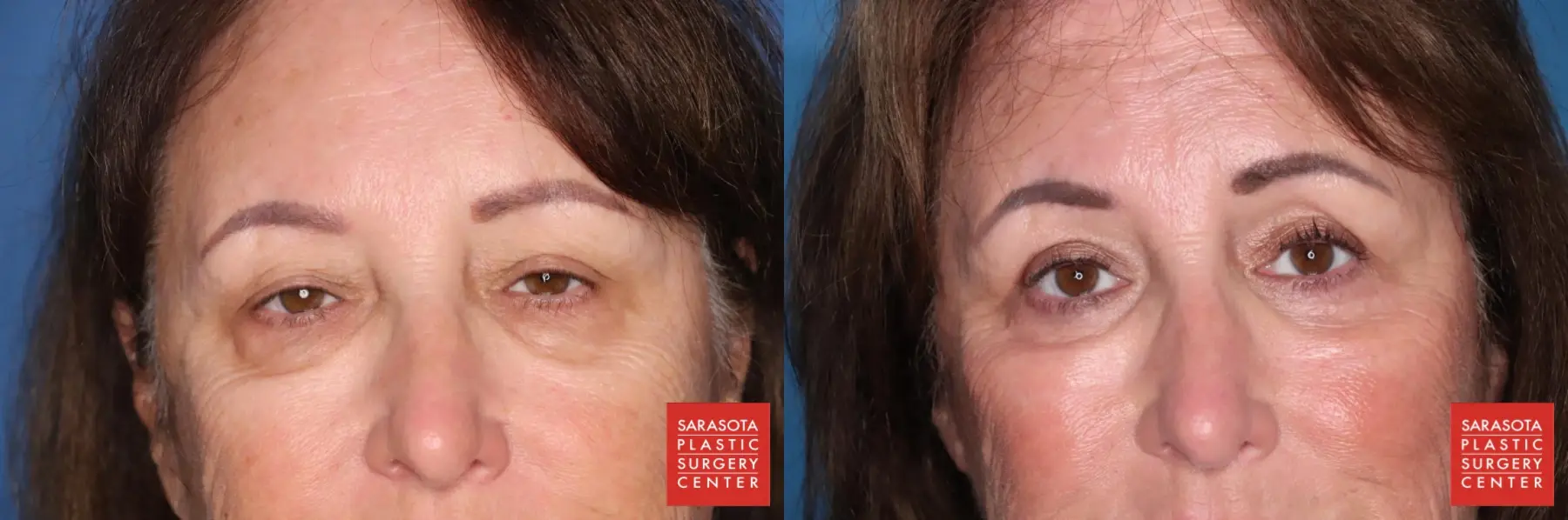 Blepharoplasty: Patient 8 - Before and After  