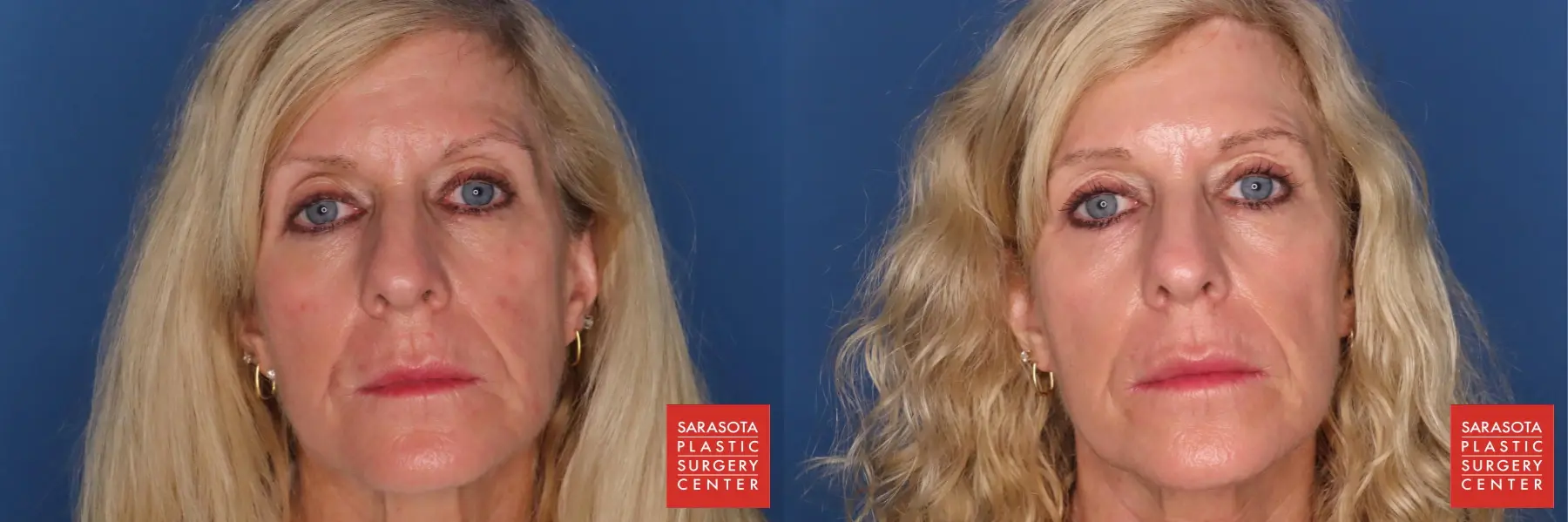 Blepharoplasty: Patient 2 - Before and After  