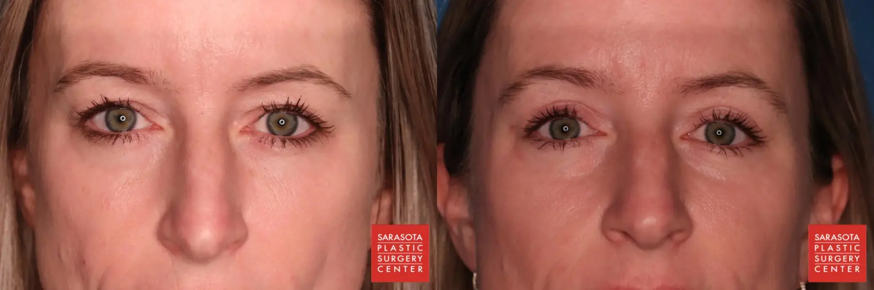Blepharoplasty: Patient 7 - Before and After  