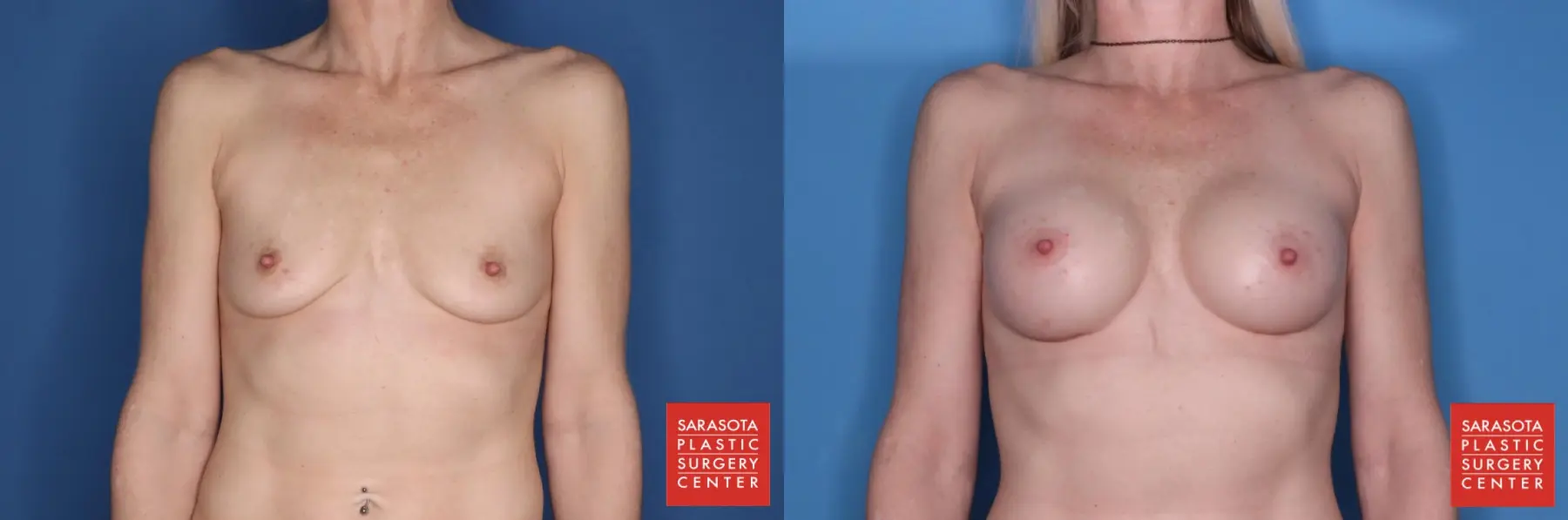 Breast Augmentation: Patient 4 - Before and After  