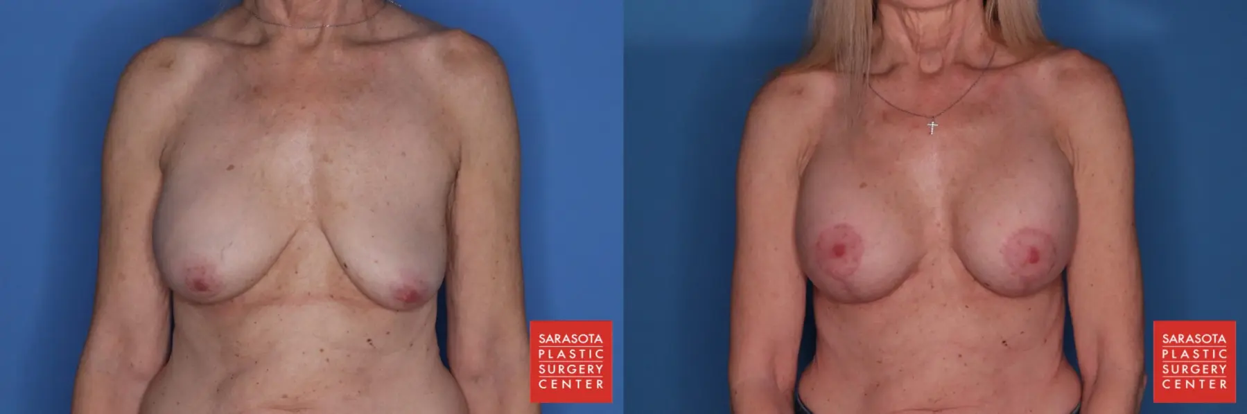 Breast Augmentation With Lift: Patient 7 - Before and After  