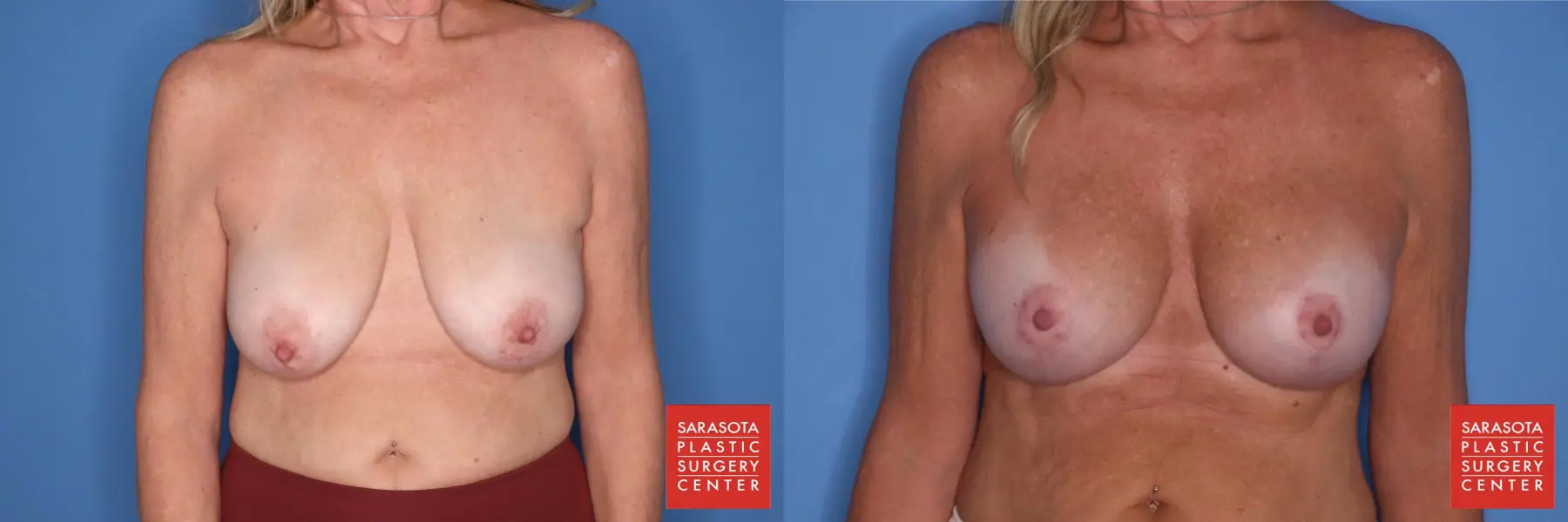 Breast Augmentation With Lift: Patient 13 - Before and After  