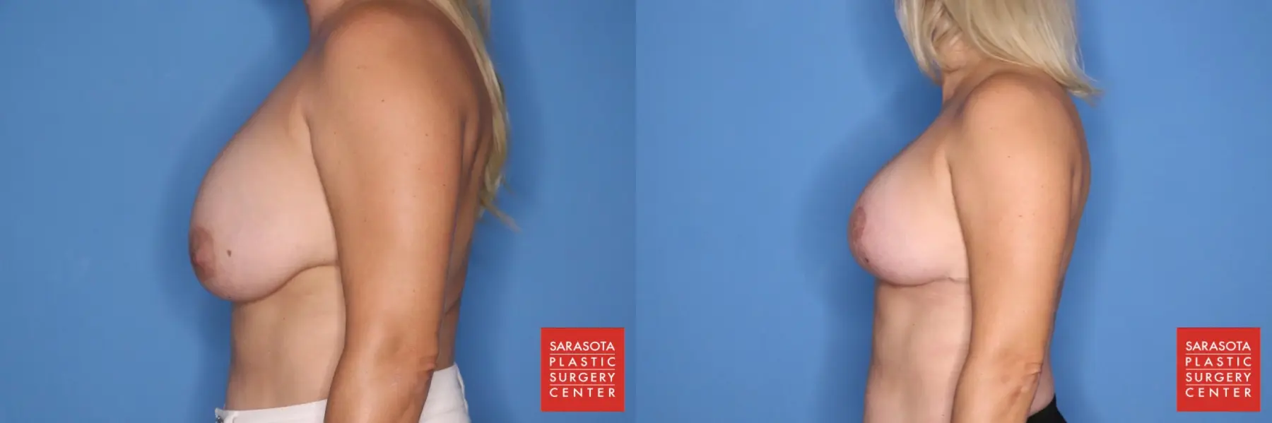 Breast Augmentation With Lift: Patient 10 - Before and After 3