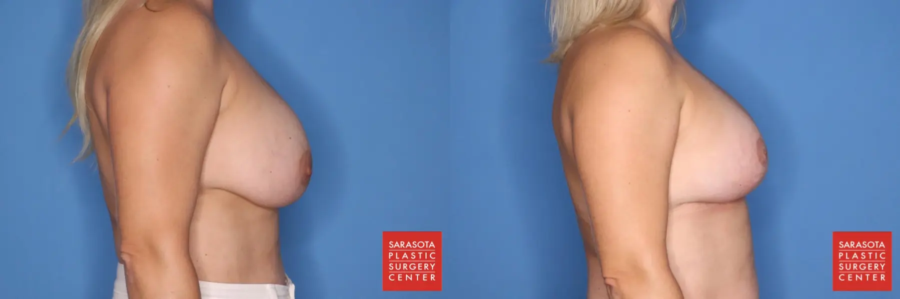 Breast Augmentation With Lift: Patient 10 - Before and After 5