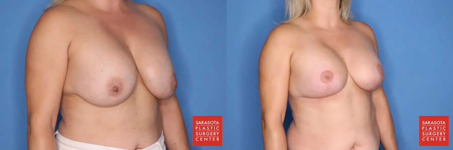 Breast Augmentation With Lift: Patient 10 - Before and After 4