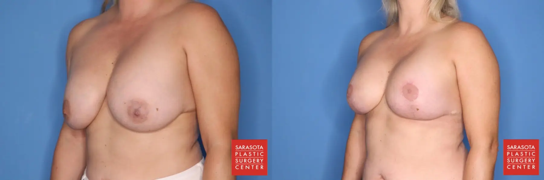 Breast Augmentation With Lift: Patient 10 - Before and After 2