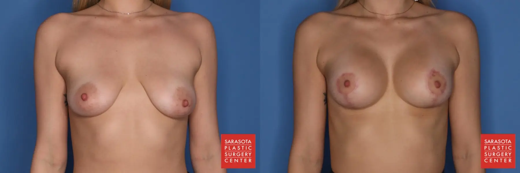 Breast Augmentation With Lift: Patient 15 - Before and After  