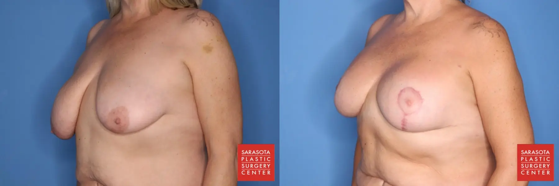 Breast Augmentation With Lift: Patient 5 - Before and After 2