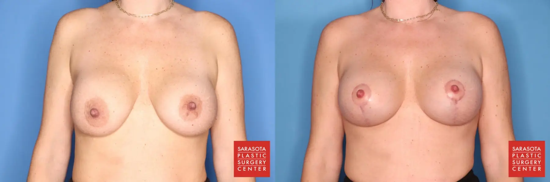 Breast Augmentation With Lift: Patient 9 - Before and After  