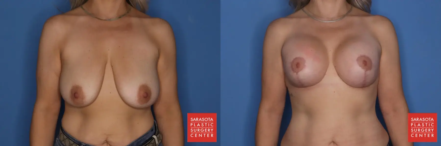 Breast Augmentation With Lift: Patient 4 - Before and After  