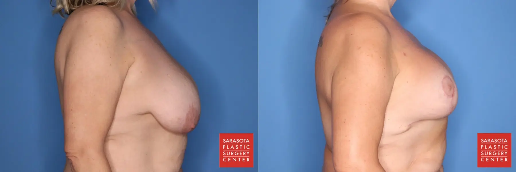 Breast Augmentation With Lift: Patient 5 - Before and After 5