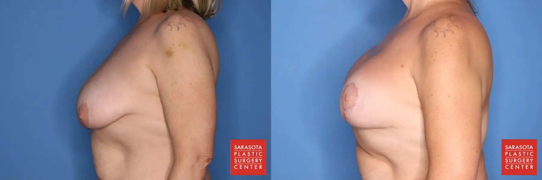 Breast Augmentation With Lift: Patient 5 - Before and After 3